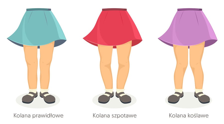 Koślawe kolana u dziecka